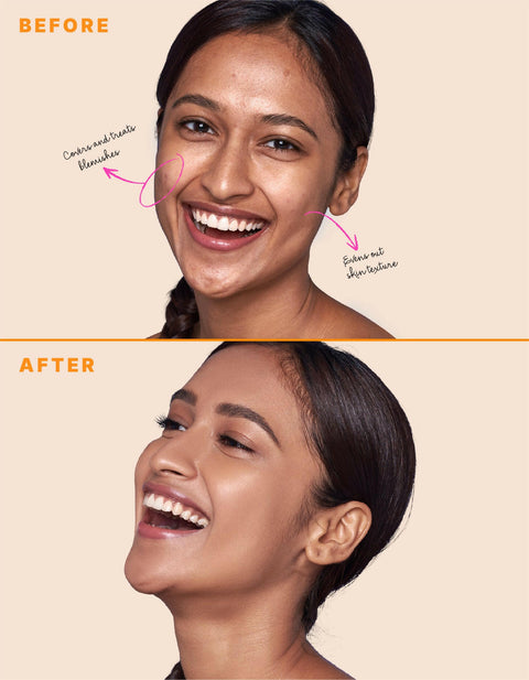 best concealer for acne prone skin